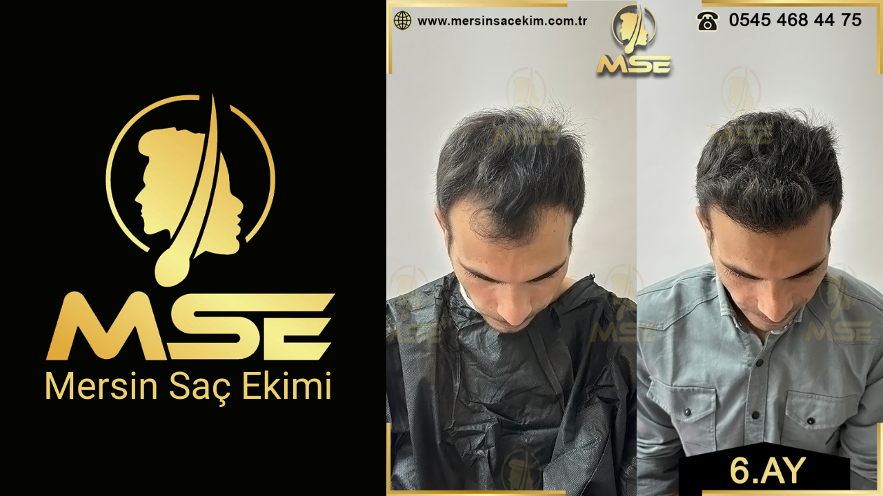 Mersin Saç Ekimi